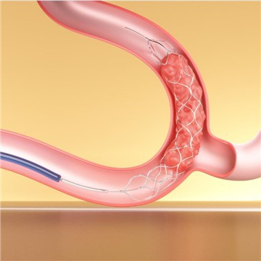 Dispositifs de thrombectomie Stent Retriever